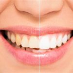 Nos conseils post-opératoires après la pose d’un implant dentaire